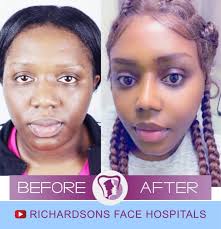 Glamorous Rhinoplasty Clinic Islamabad - Nose Reshaping