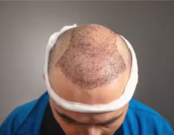 Hair transplant in Islamabad